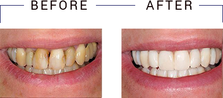 Cape Cod Dental | Emergency Treatment, Dental Bridges and Extractions